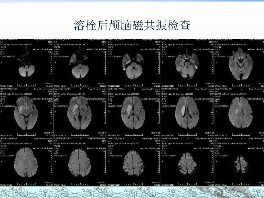 急性脑梗死动脉取栓治疗ppt医学课件_第5页