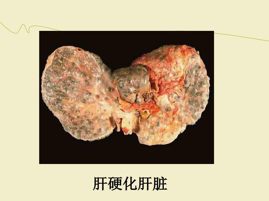 肝硬化腹水病人的护理ppt医学课件_第4页