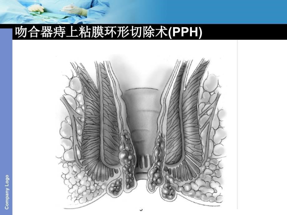 吻合器痔上粘膜环形切除术(PPH)参考PPT_第5页