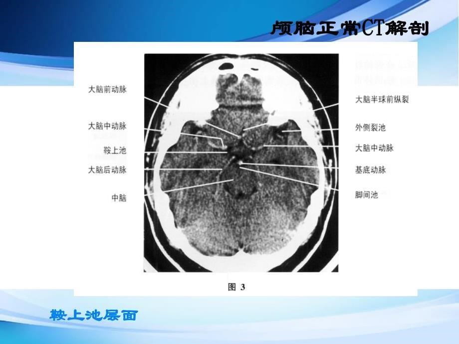 头部 C T解剖及诊断基础ppt医学课件_第5页