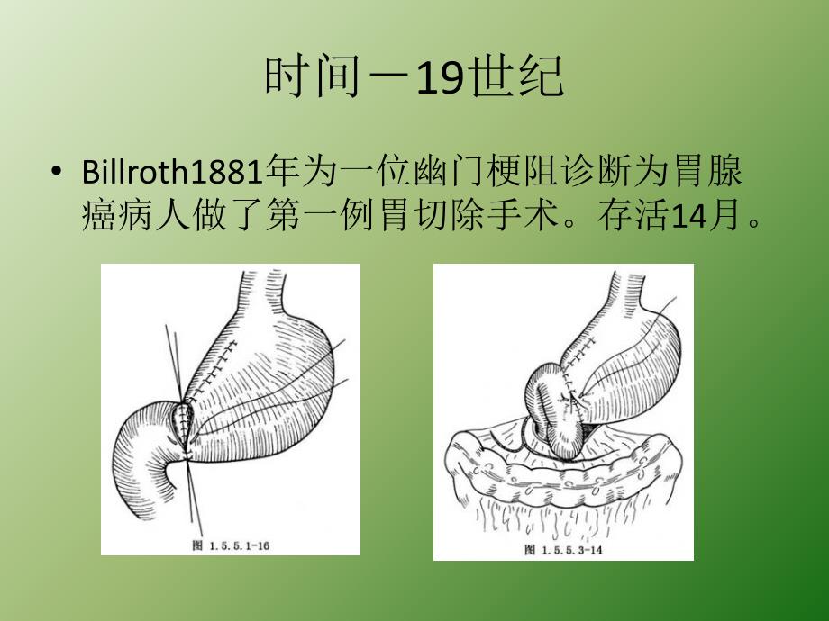 胃癌的世界ppt医学课件_第4页