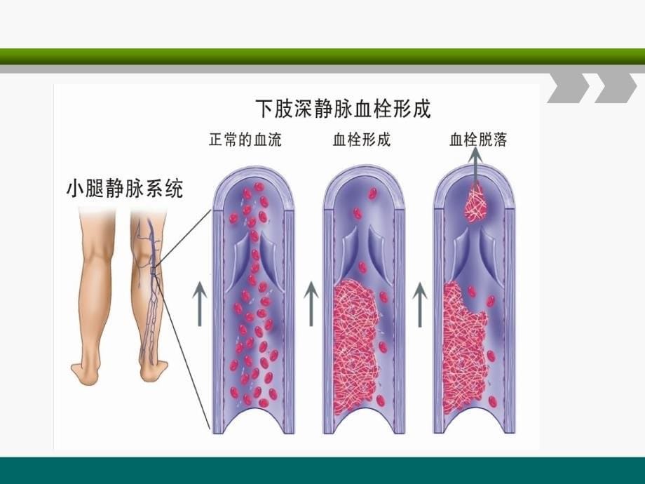 下肢深静脉血栓的护理查房参考PPT_第5页