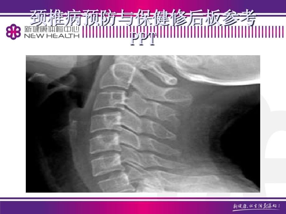 颈椎病预防与保健修后板参考PPT_第5页