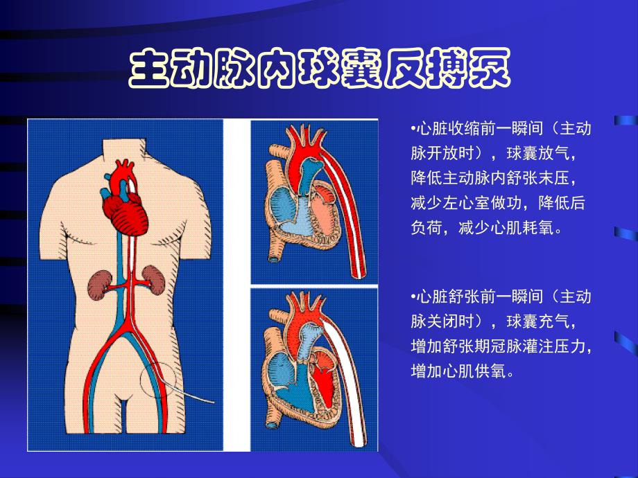 主动脉内球囊反搏泵参考PPT_第3页