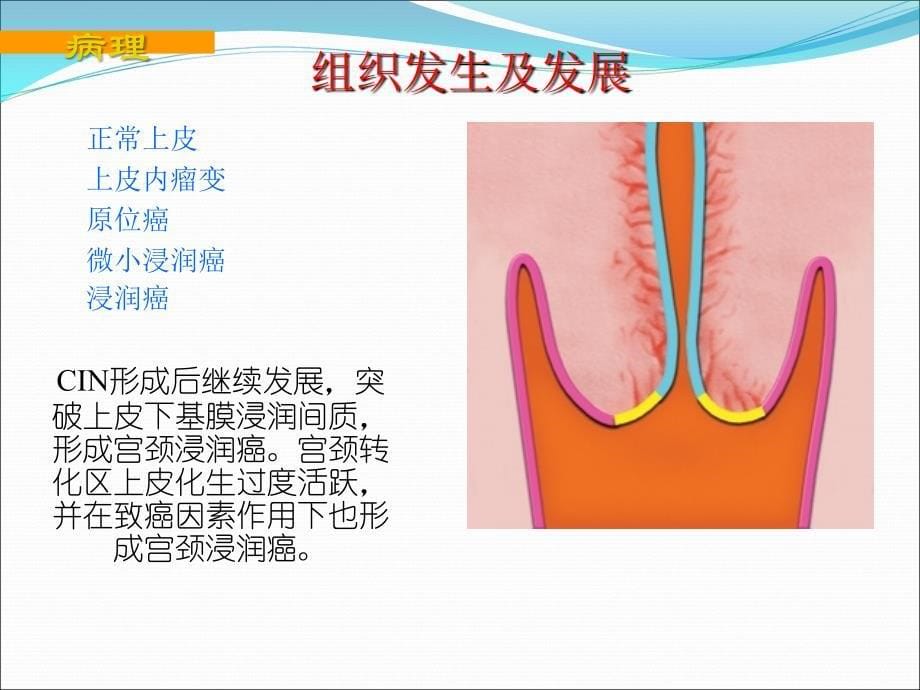 子宫颈癌护理查房ppt医学课件_第5页