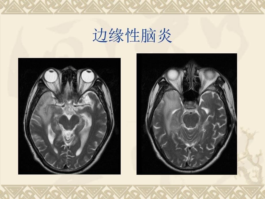 边缘性脑炎参考PPT_第5页