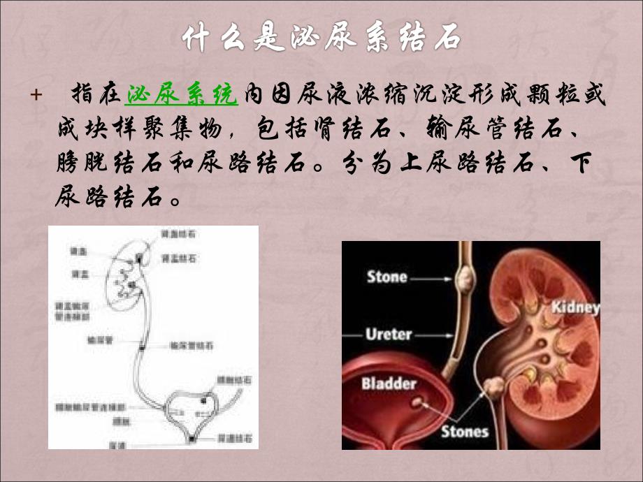 结石病人的饮食指导ppt医学课件_第3页