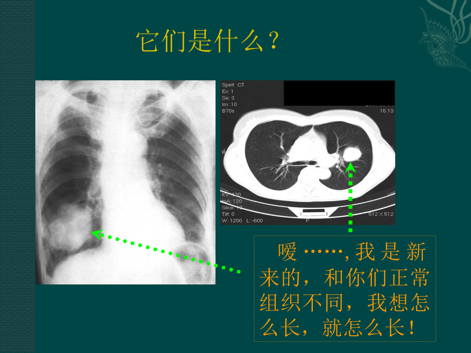 原发性支气肺癌ppt医学课件_第2页