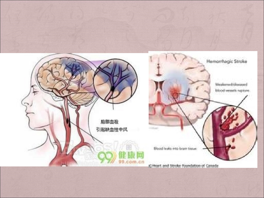 认识中风ppt医学课件_第3页