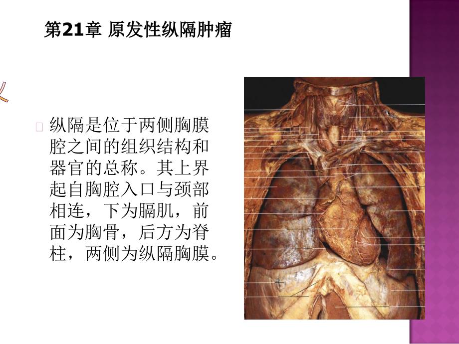 原发性纵隔肿瘤PPT课件_第3页