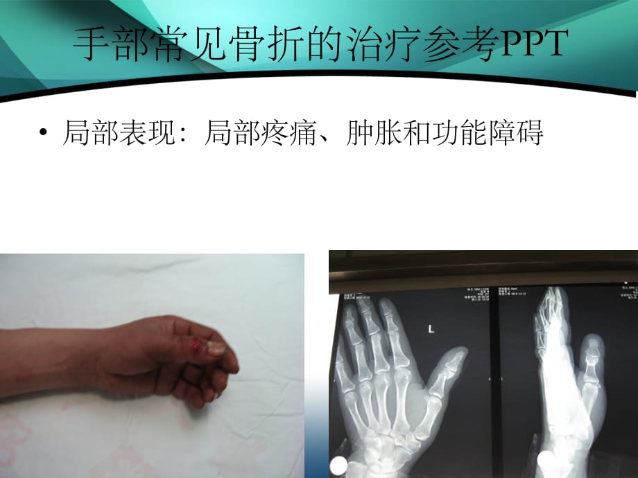 手部常见骨折的治疗参考PPT_第5页