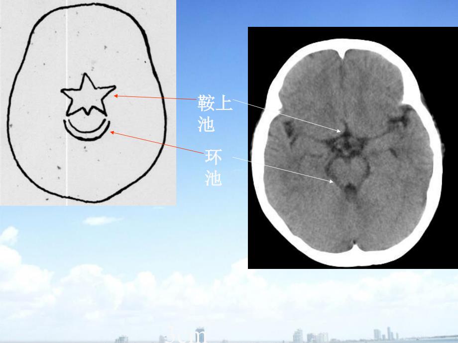 头颅 C T解剖ppt医学课件_第3页