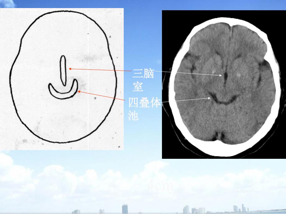 头颅 C T解剖ppt医学课件_第4页