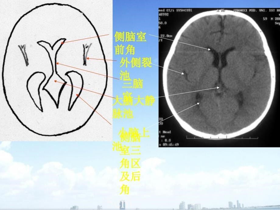 头颅 C T解剖ppt医学课件_第5页