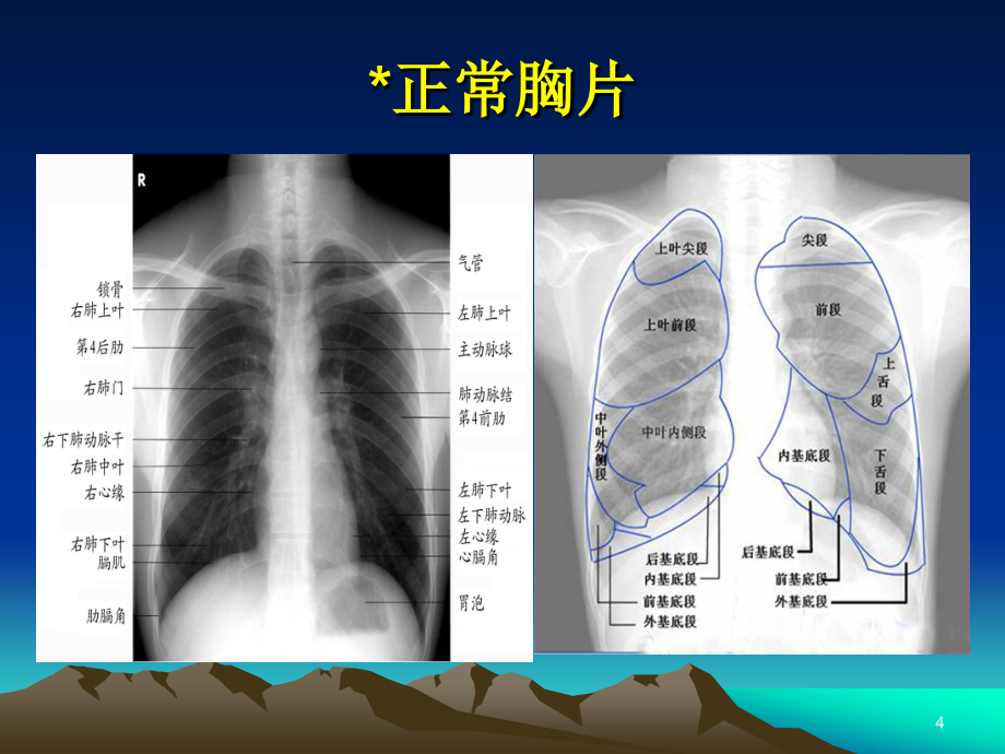 神经内科呼吸系统炎性病变ppt医学课件_第4页