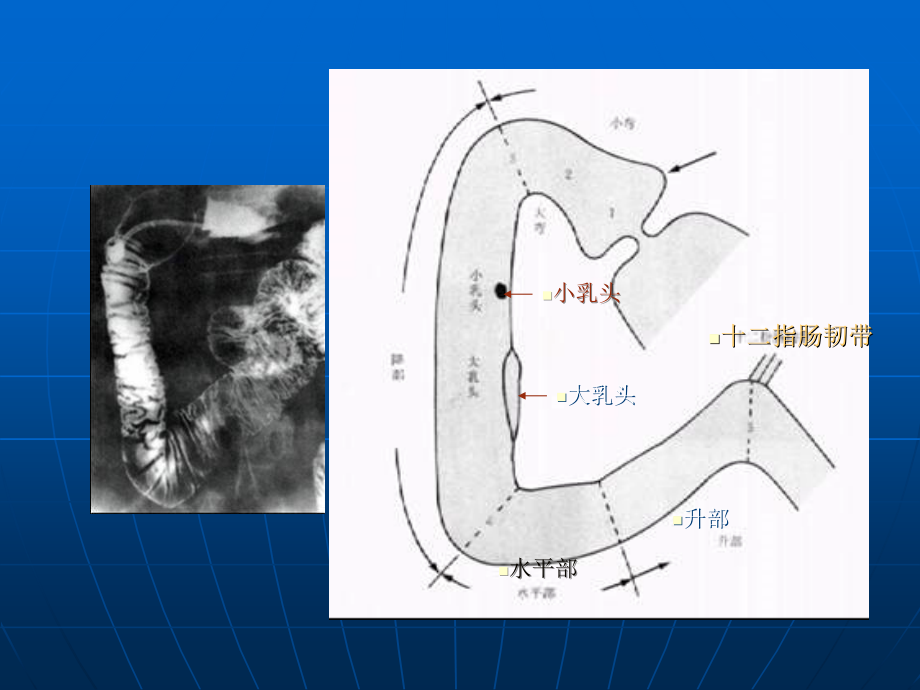 十二指肠疾病ppt医学课件_第3页