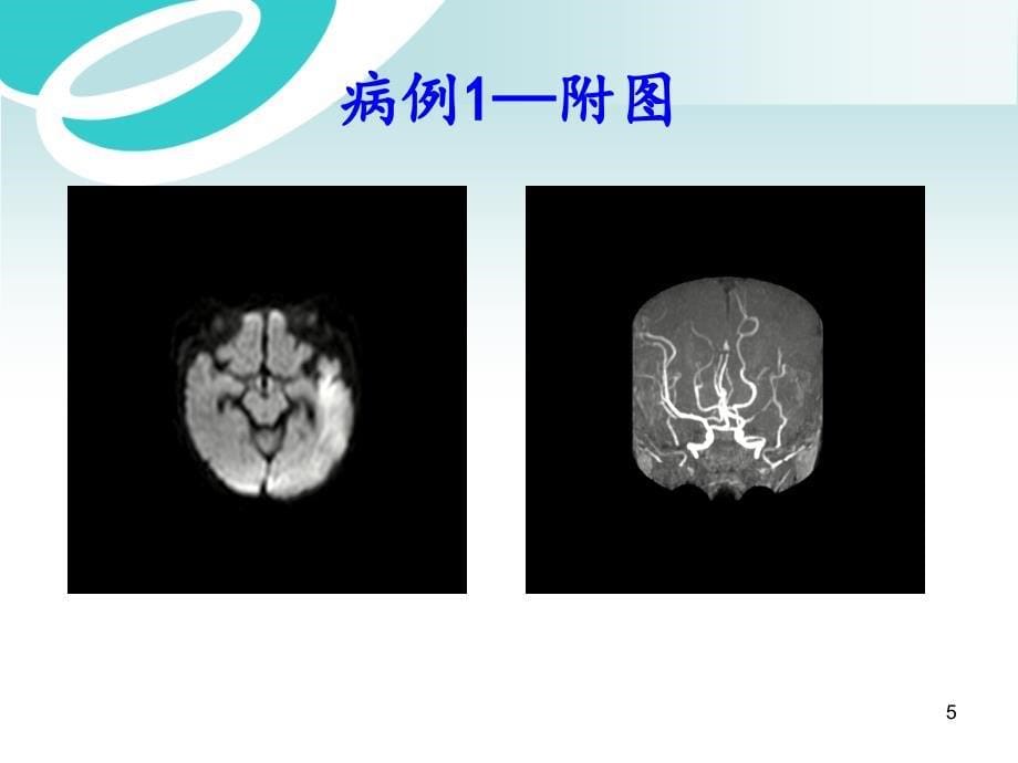 中枢神经系统感染白色念珠菌病ppt医学课件_第5页