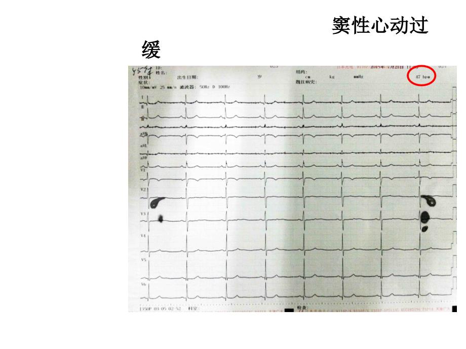 心电图带教ppt医学课件_第4页