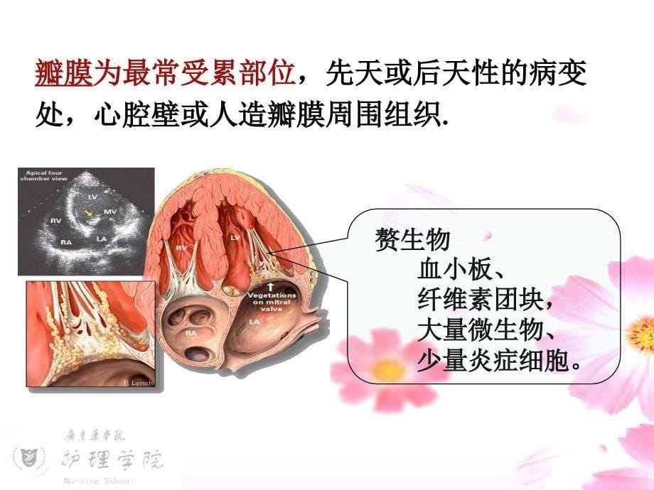 感染性心内膜炎的护理ppt医学课件_第5页