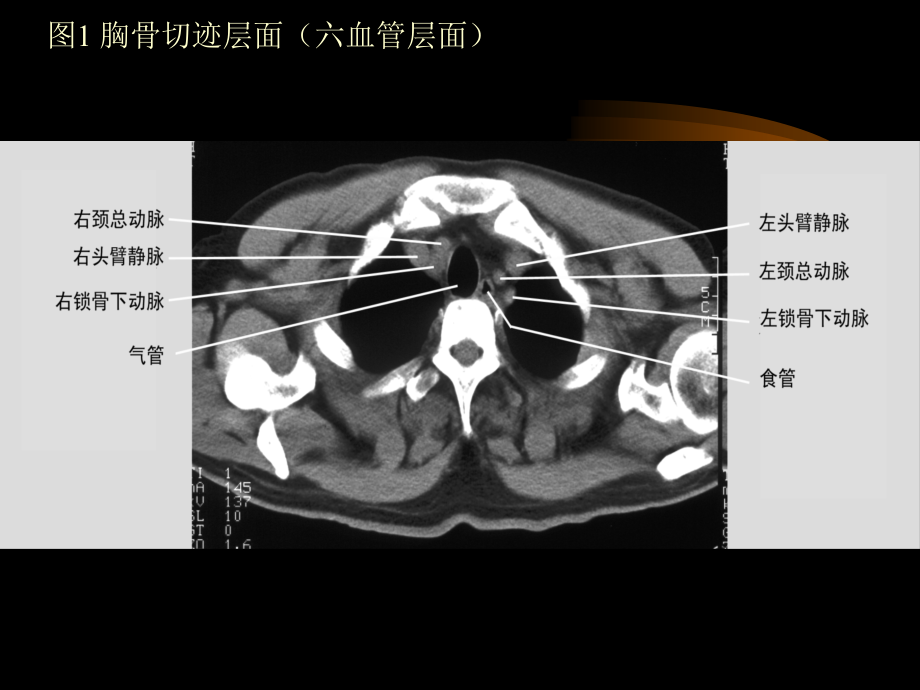 胸部 C T诊断学ppt医学课件_第4页