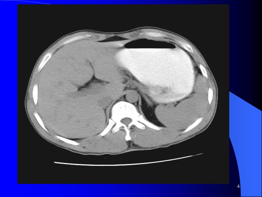 影像图谱系列腹部 C T经典ppt医学课件_第4页