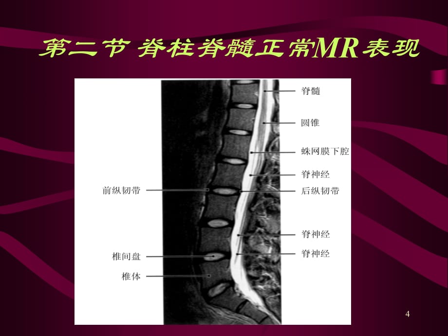 脊椎MR诊断课件PPT_第4页