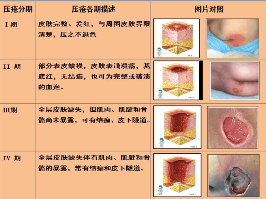 压疮的护理常规课件PPT_第5页