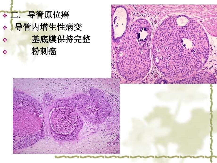 女性生殖系统和乳腺疾病课件PPT_第5页