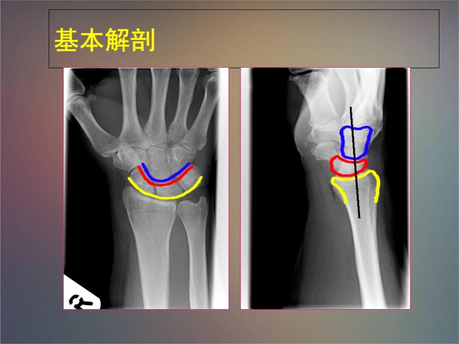 腕肘关节损伤MRI教学文案_第3页