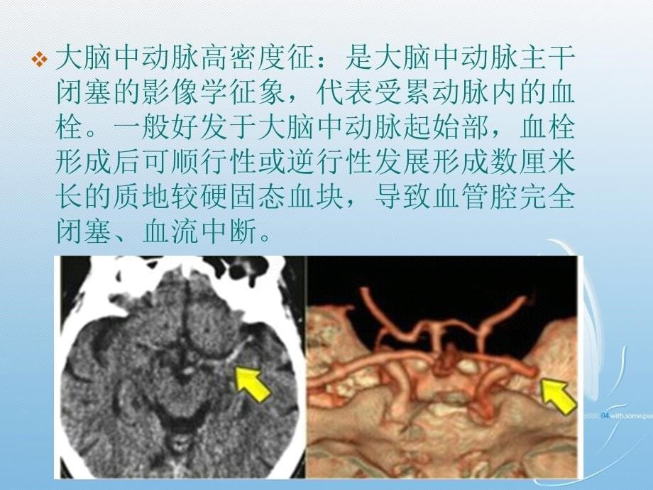 超早期脑梗死的CT影像表现及诊断课件PPT_第5页