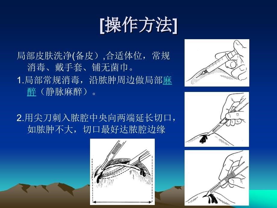 脓肿切开换药拆线课件PPT_第5页