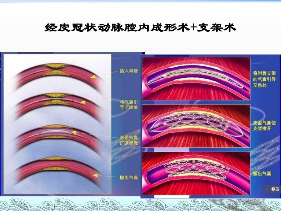 冠心病手术简介课件PPT_第5页