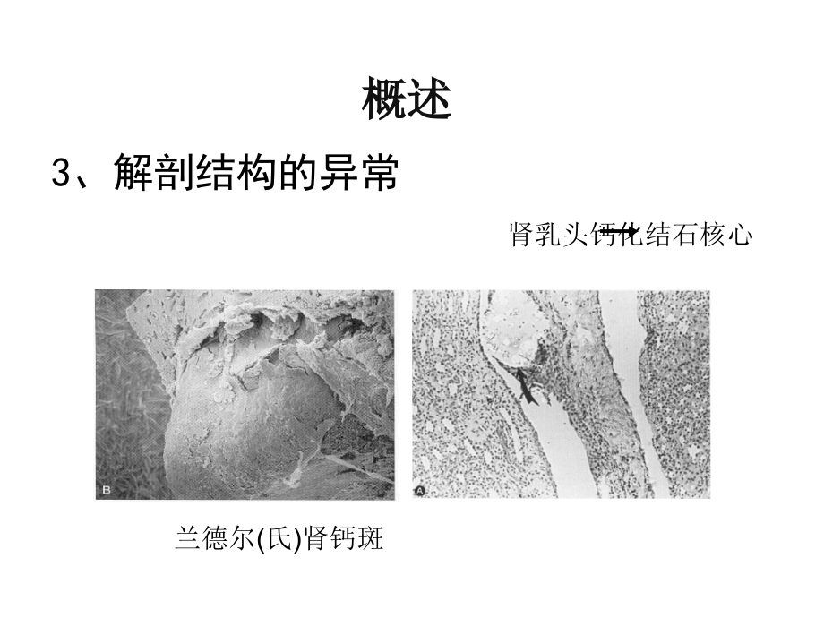 泌尿系结石的诊疗课件PPT_第4页