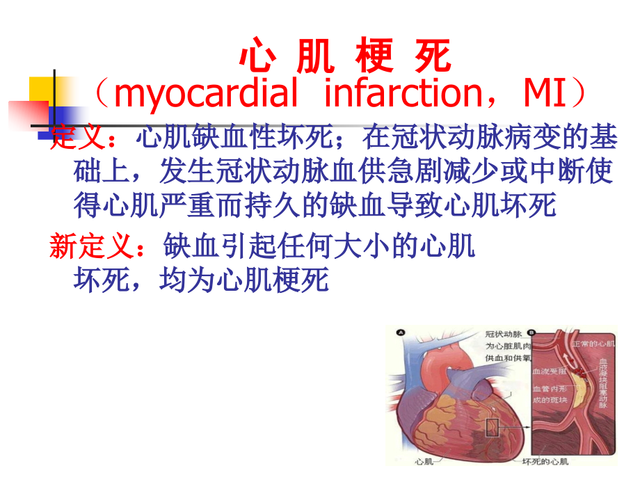 急性心肌梗死的识别课件PPT_第4页