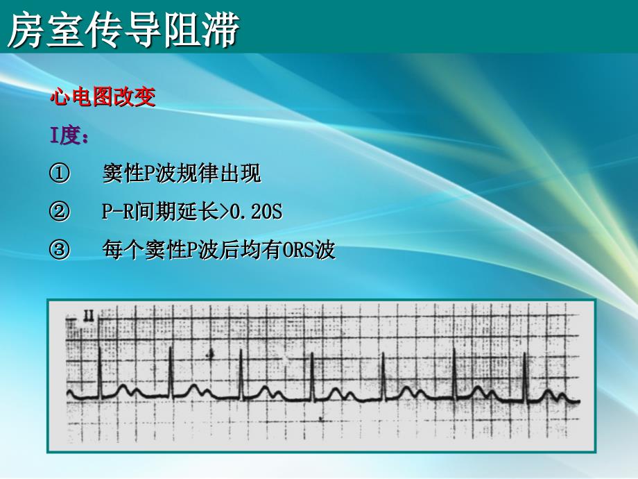 房室传导阻滞课件PPT_第3页