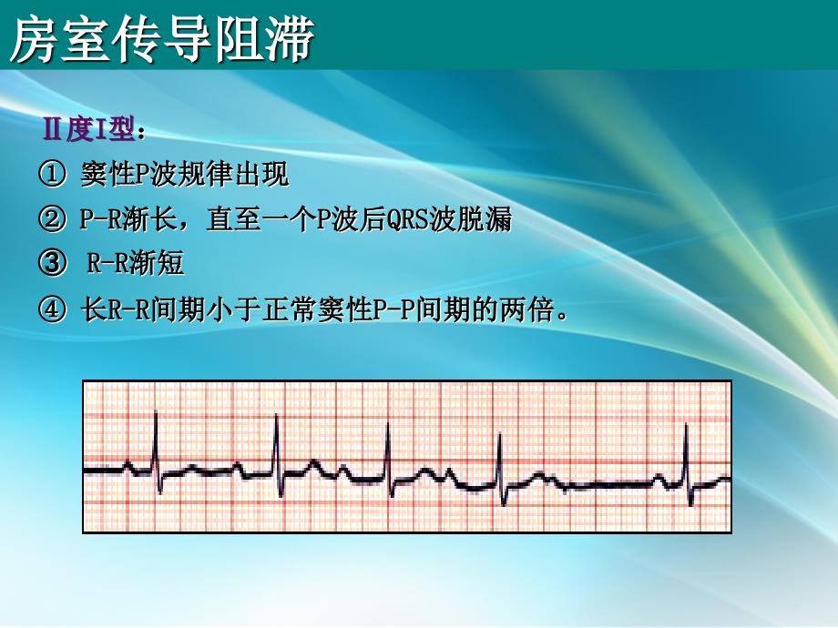 房室传导阻滞课件PPT_第4页