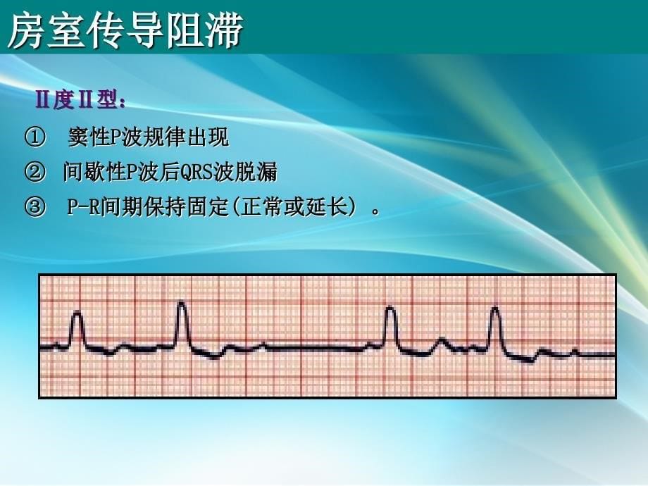 房室传导阻滞课件PPT_第5页