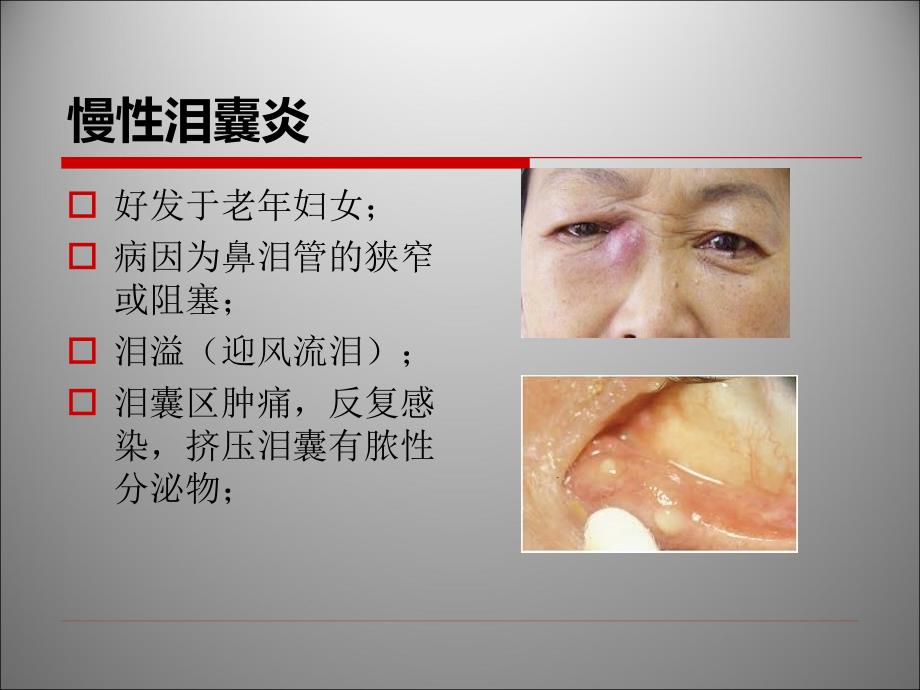 鼻内镜鼻腔泪囊吻合术课件PPT_第3页