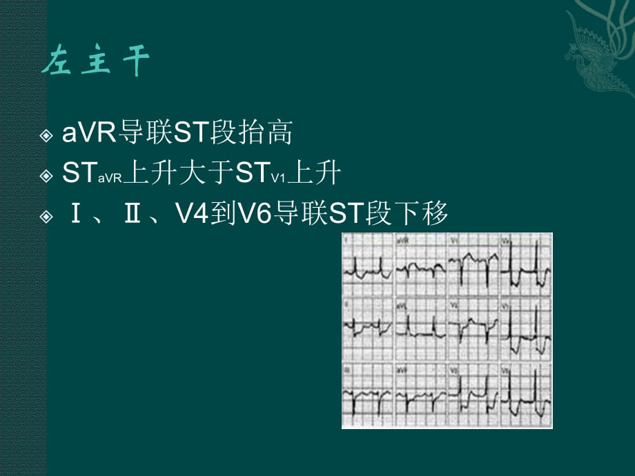 心肌梗死心电图的定位课件PPT_第4页