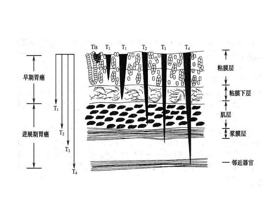 2017胃癌诊治策略课件PPT_第5页