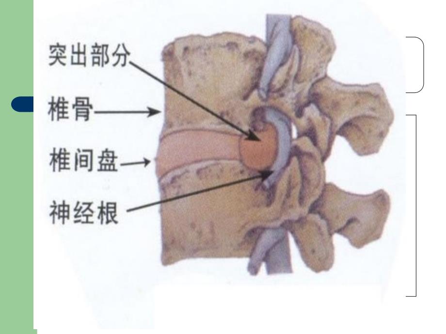 腰痛与委中课件PPT_第4页