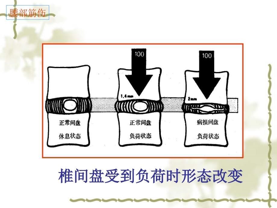 腰痛与委中课件PPT_第5页