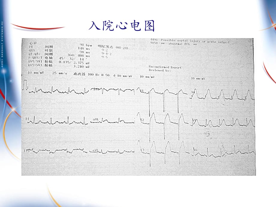 急性心肌梗死左主干病变介入治疗课件PPT_第4页