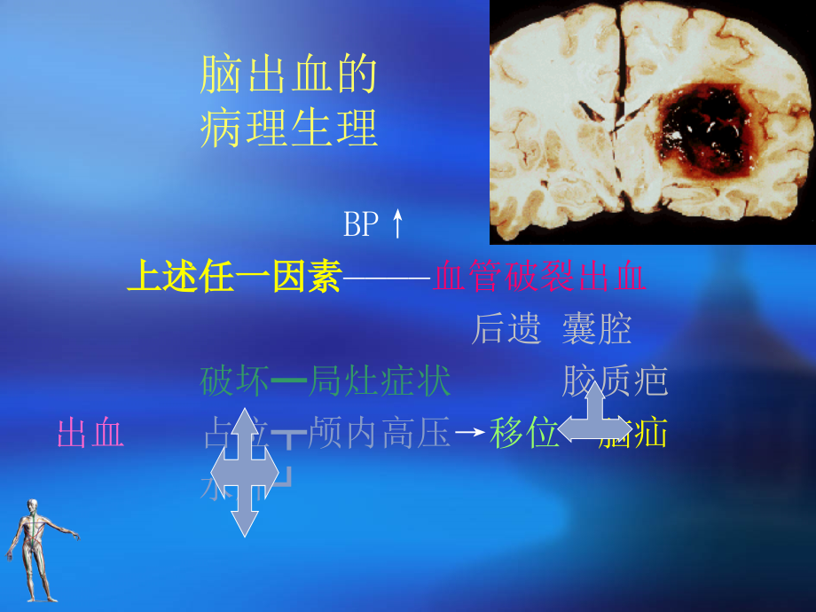 脑出血CerebralHaemorrahge课件PPT_第2页