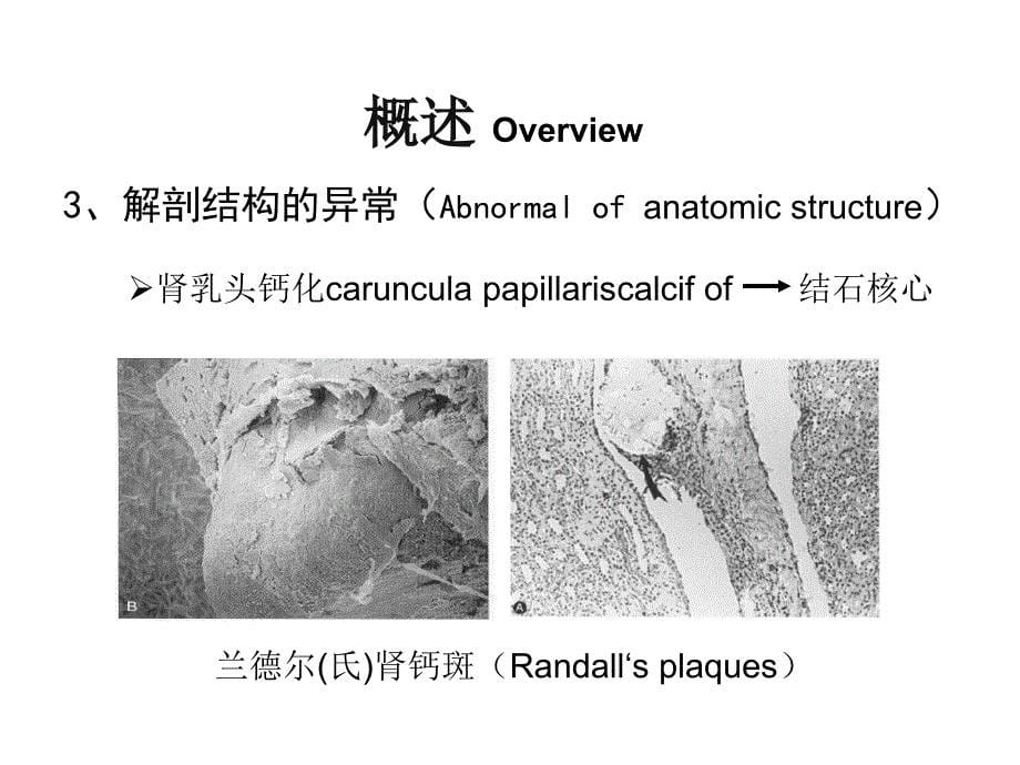 教学版泌尿系结石课件PPT_第5页