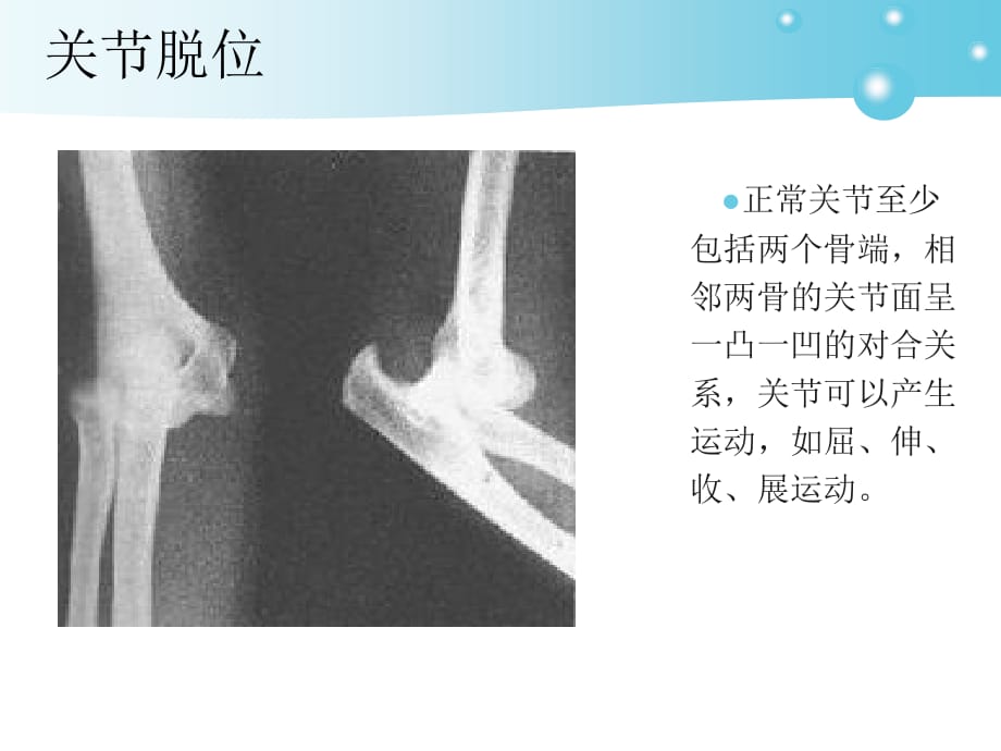 关脱位护理课件PPT_第4页