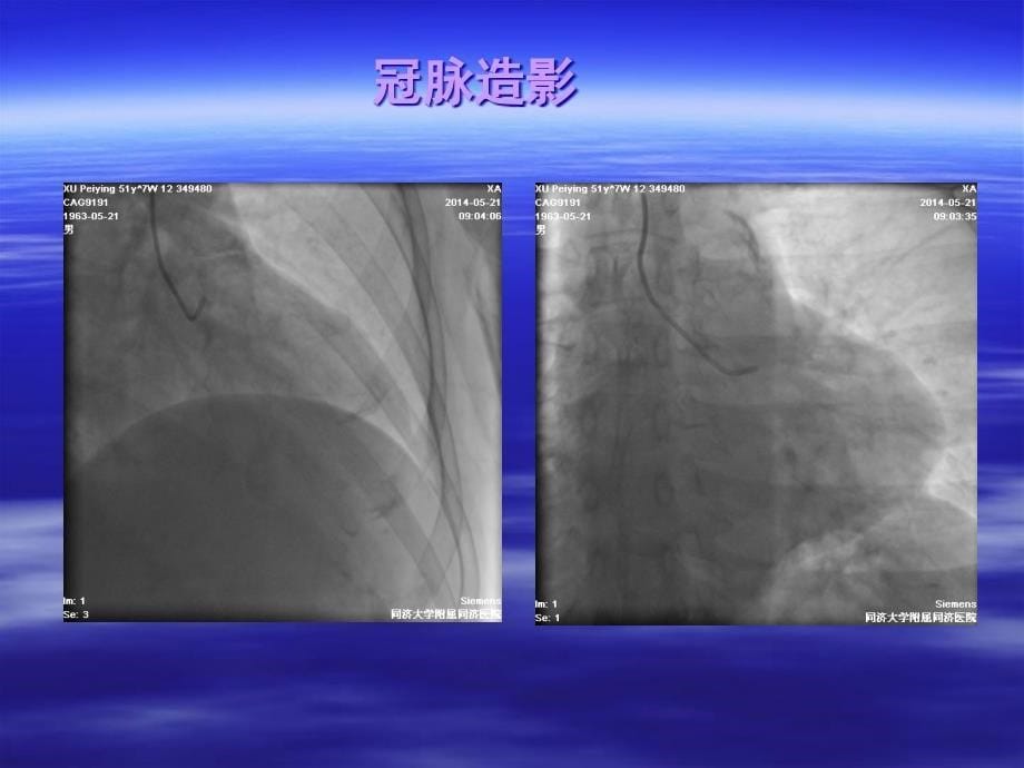 冠状动脉造影术适应证与禁忌证课件PPT_第5页