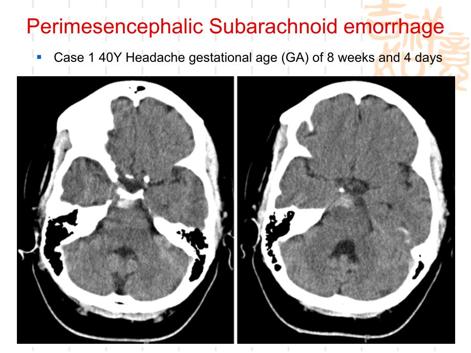 妊娠和产褥期动脉瘤性蛛网膜下腔出血的诊疗课件PPT_第4页
