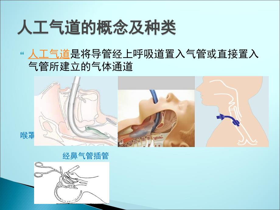 人工气道管理新进展课件PPT_第2页