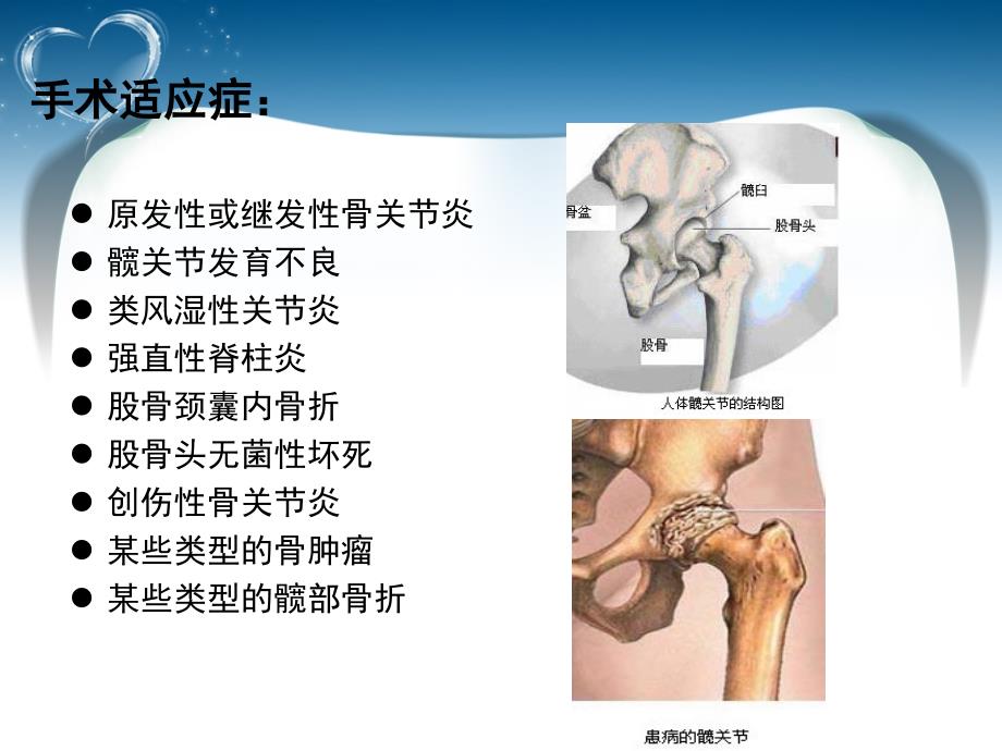 髋关置换术后功能锻炼健康指导课件PPT_第2页